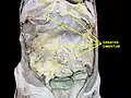 Greater omentum. Deep dissection.